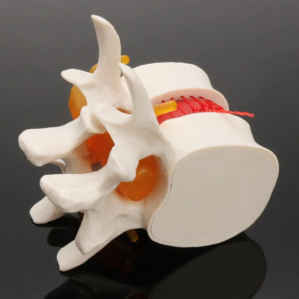 White PVC anatomical model of a human lumbar intervertebral disc showing herniation.
