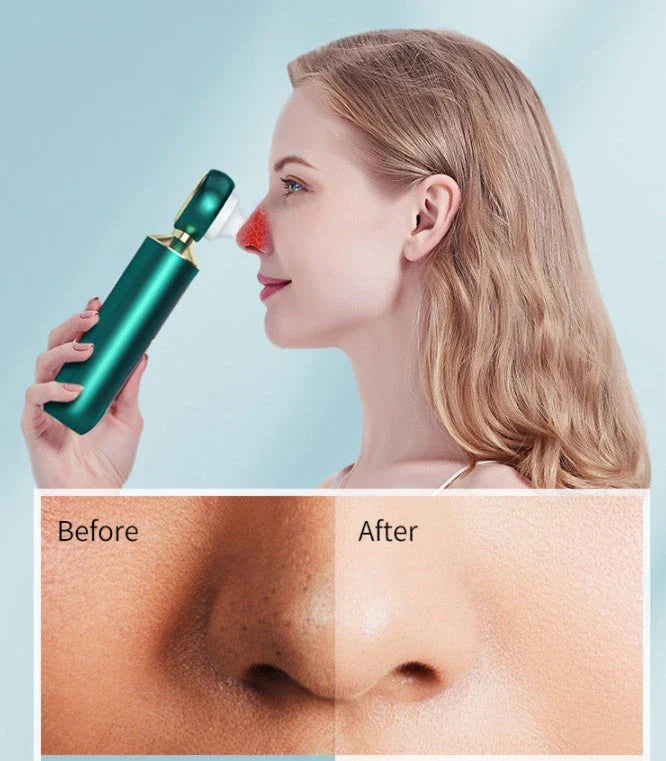 Advanced blackhead remover with LED magnifier and suction cleansing for flawless, radiant skin