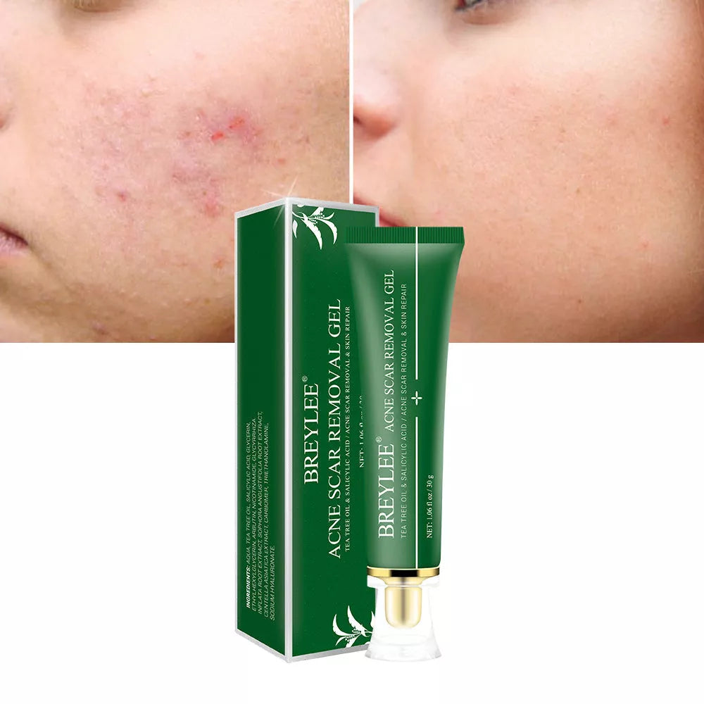 Acne scar removal gel with tea tree oil, 30g size, compact and effective for daily skincare