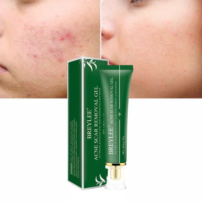 Acne scar removal gel with tea tree oil, 30g size, compact and effective for daily skincare