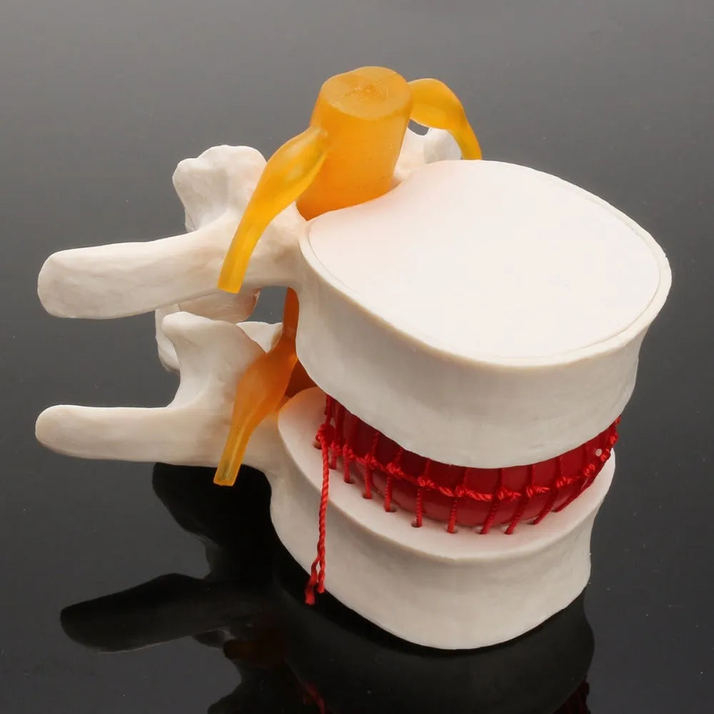 White PVC anatomical model of a human lumbar intervertebral disc showing herniation.