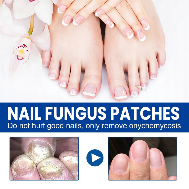 Nail care adhesive bandage repair stickers with 32 patches per box featuring glycerin, allantoin, garlic extract, tea tree oil, and vitamin E for damaged or weak nail nursing and recovery