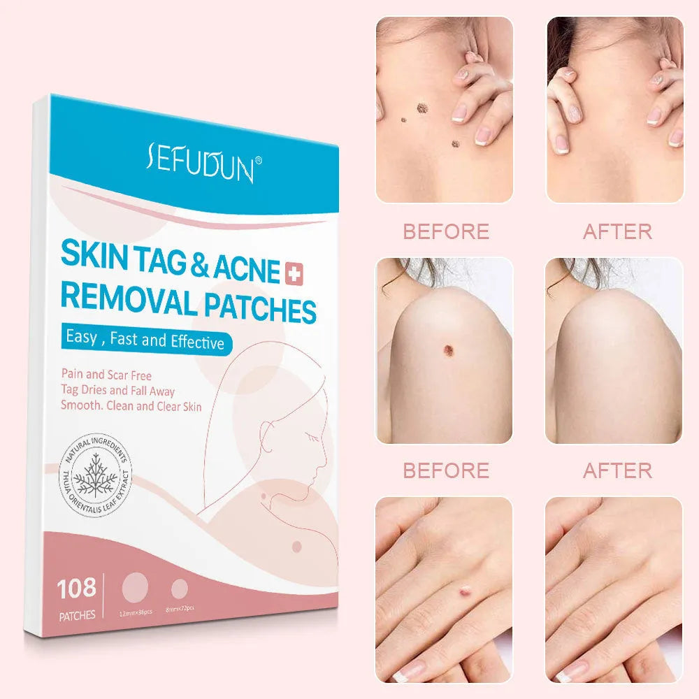 108 white vitamin A skin tag remover patches for wart and acne care at home