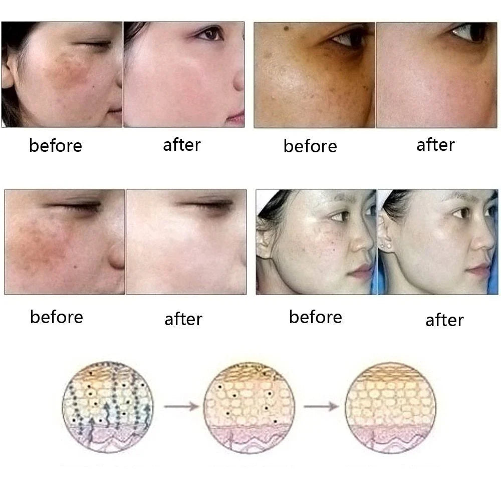 Ultra-Brightening Acne & Scar Removal Essence Oil - Visibly Diminish Dark Spots and Discoloration for Radiant, Even-Toned Skin