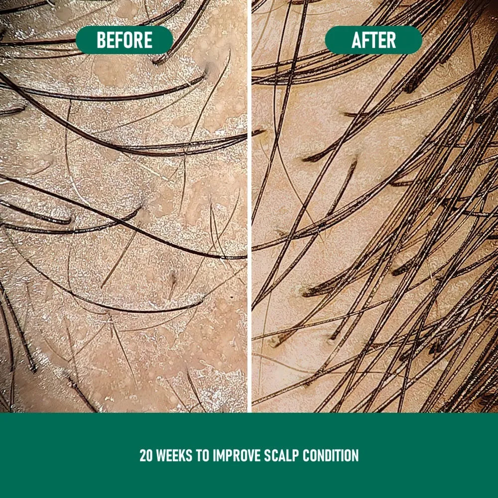 CH004 Minoxidil 5% Anti-Hair Loss Mousse 60g canister bottle for hair regrowth treatment