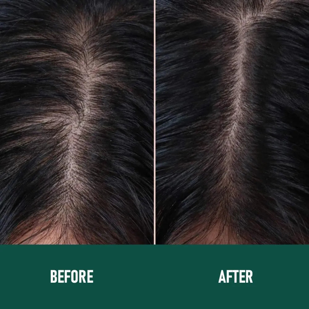 CH004 Minoxidil 5% Anti-Hair Loss Mousse 60g canister bottle for hair regrowth treatment