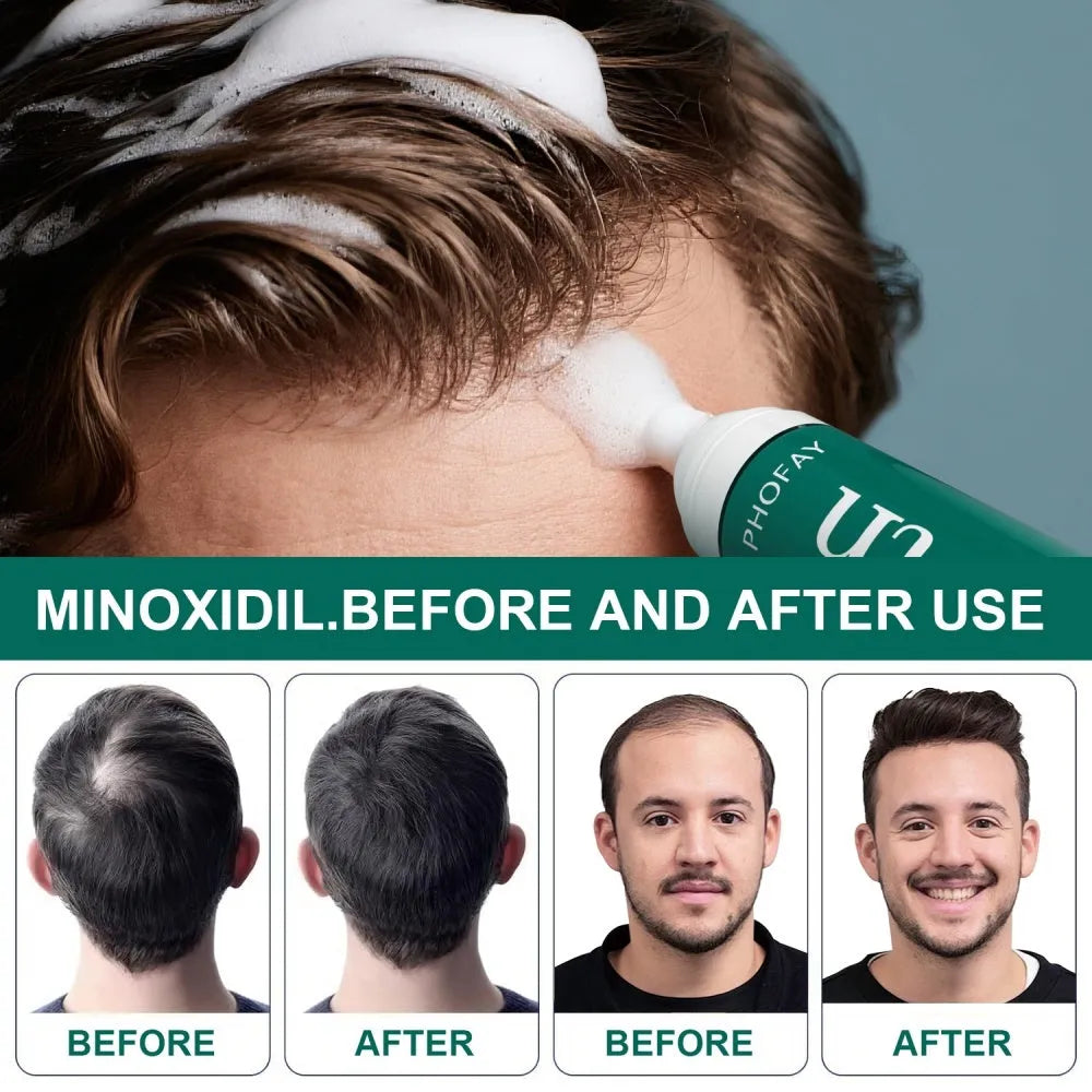 CH004 Minoxidil 5% Anti-Hair Loss Mousse 60g canister bottle for hair regrowth treatment