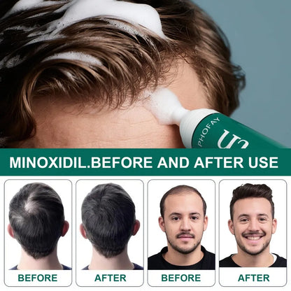 CH004 Minoxidil 5% Anti-Hair Loss Mousse 60g canister bottle for hair regrowth treatment