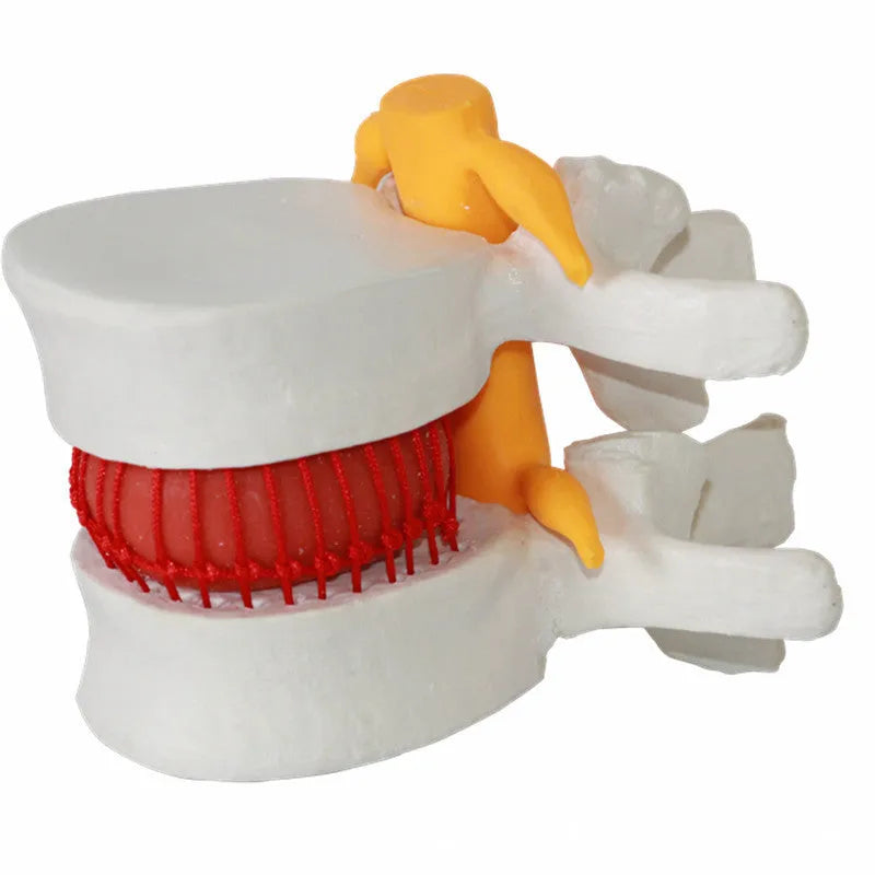 White PVC anatomical model of a human lumbar intervertebral disc showing herniation.