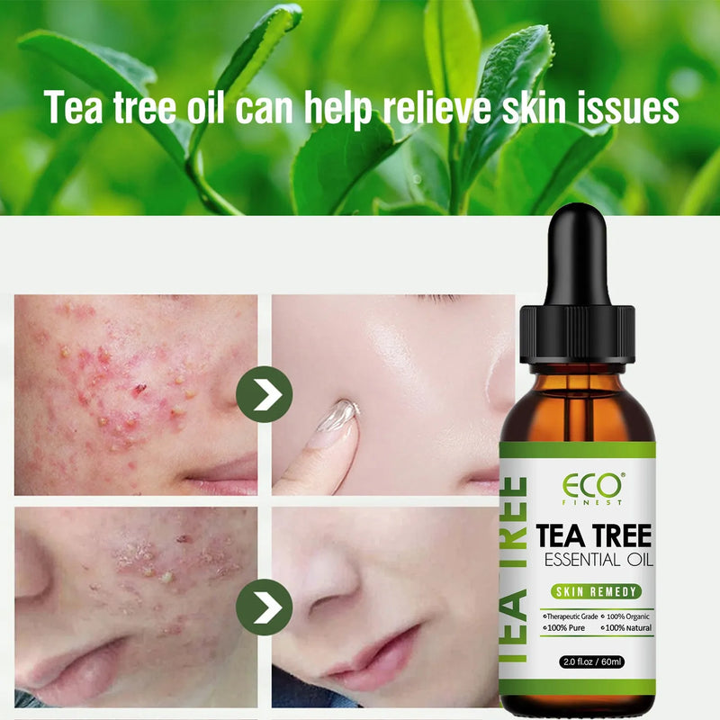 Tea Tree Essential Oil 60ml Massage Oil for Acne Prone Skin and Face Care Aromatherapy Treatment with Pure Tea Tree Formula for Spot Reduction and Natural Skincare Solution