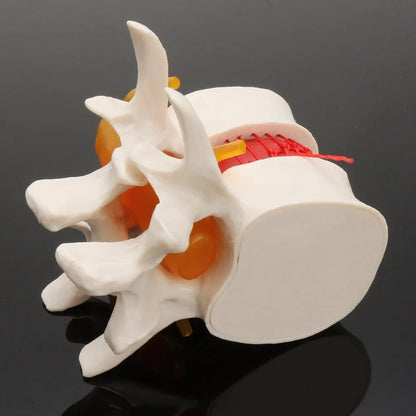 White PVC anatomical model of a human lumbar intervertebral disc showing herniation.