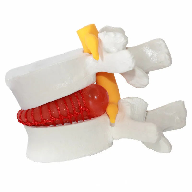White PVC anatomical model of a human lumbar intervertebral disc showing herniation.
