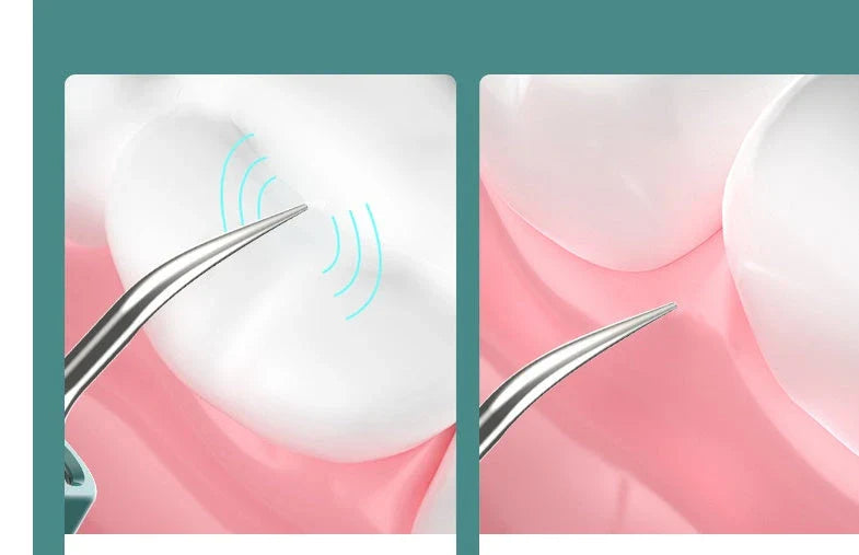 Ultrasonic Dental Plaque Remover with stainless steel and silicone construction, powerful vibrations, and USB charging