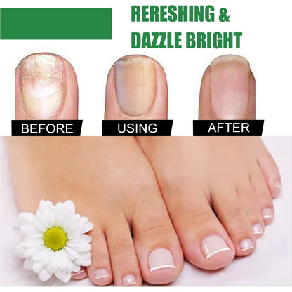 30ml bottle of tea tree oil nail repair fluid for hand and foot nail treatment