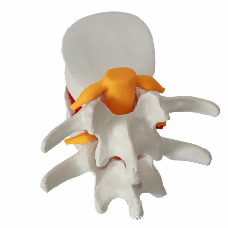 White PVC anatomical model of a human lumbar intervertebral disc showing herniation.