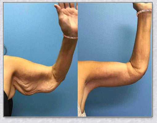 A stylish magnetic bracelet designed to stimulate lymphatic drainage and improve overall circulation for better health and wellness.