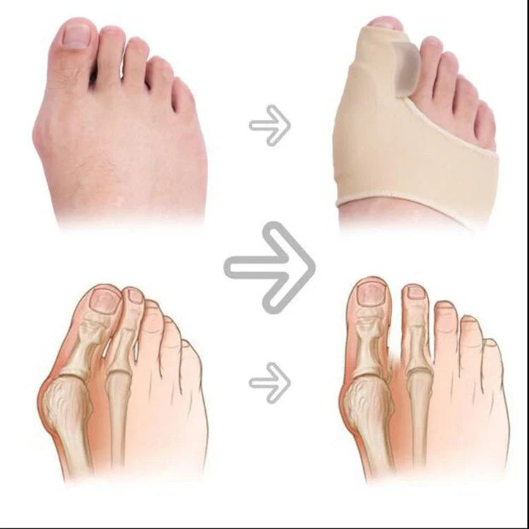 Big Foot Valgus Corrector in skin tone and white, showcasing its lightweight design and protective cover.