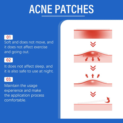 216 tea tree oil acne patches for gentle blemish treatment with vitamin E