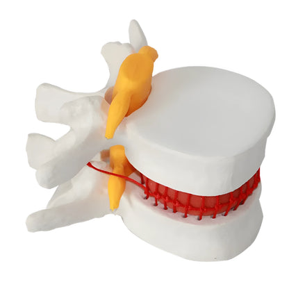 White PVC anatomical model of a human lumbar intervertebral disc showing herniation.