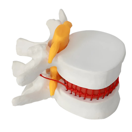 White PVC anatomical model of a human lumbar intervertebral disc showing herniation.