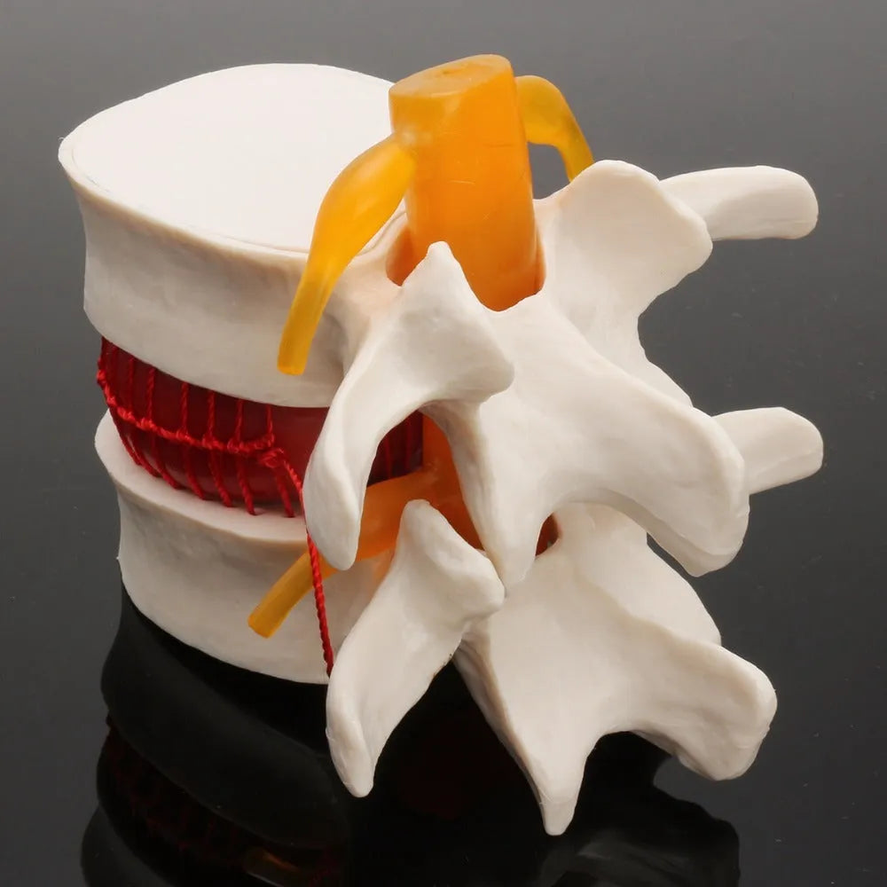 White PVC anatomical model of a human lumbar intervertebral disc showing herniation.