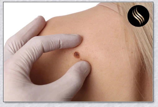 Skin Tag And Mole Remover - Innovative nano-needle technology for safe and effective removal of skin tags, moles, freckles, and other blemishes
