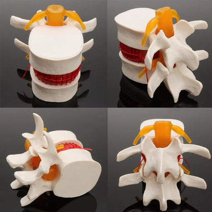 White PVC anatomical model of a human lumbar intervertebral disc showing herniation.