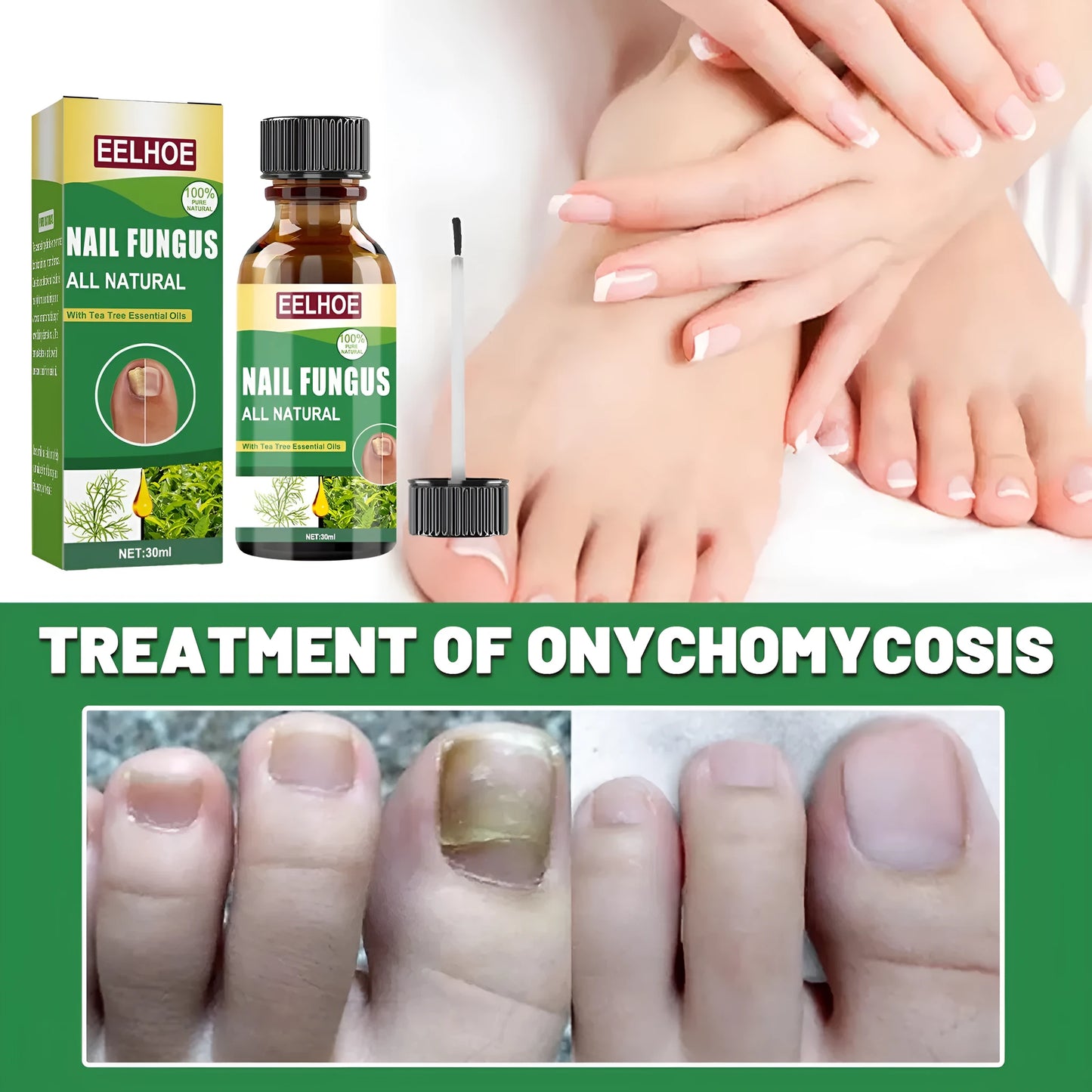 30ml bottle of tea tree oil nail repair fluid for hand and foot nail treatment