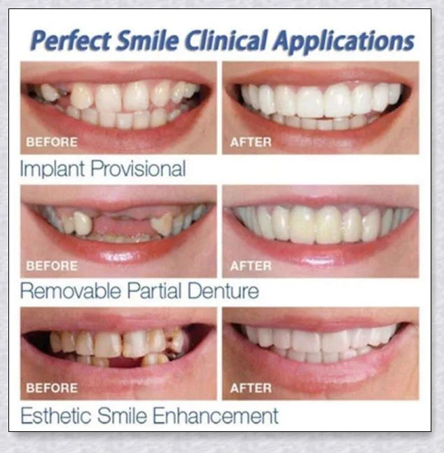 Snap-On Veneers that instantly transform your smile by disguising crooked, stained, or missing teeth