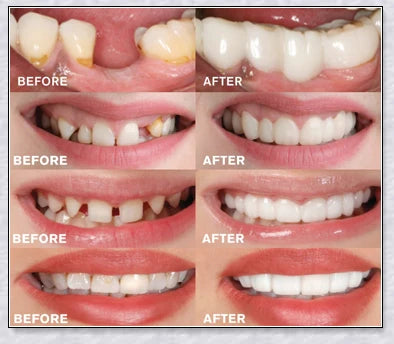 Snap-On Veneers that instantly transform your smile by disguising crooked, stained, or missing teeth
