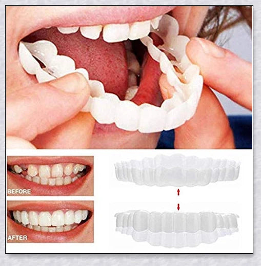 Snap-On Veneers that instantly transform your smile by disguising crooked, stained, or missing teeth