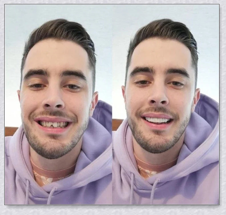 Hhomeenjoy US Snap-On Veneers (Top & Bottom)