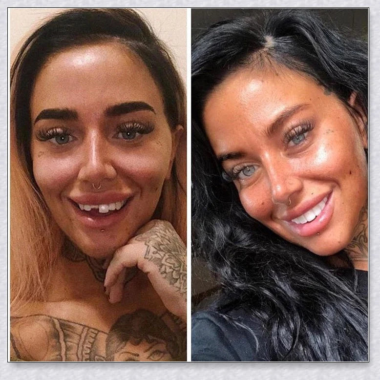 Snap-On Veneers that instantly transform your smile by disguising crooked, stained, or missing teeth