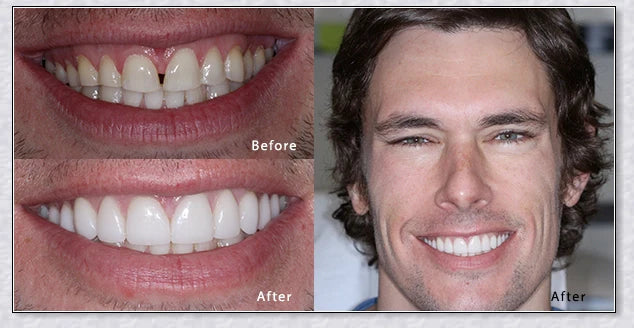 Snap-On Veneers that instantly transform your smile by disguising crooked, stained, or missing teeth