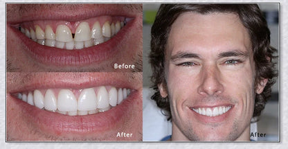 Snap-On Veneers that instantly transform your smile by disguising crooked, stained, or missing teeth