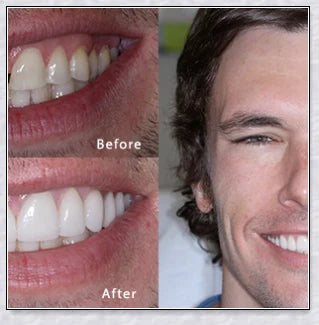 Snap-On Veneers that instantly transform your smile by disguising crooked, stained, or missing teeth