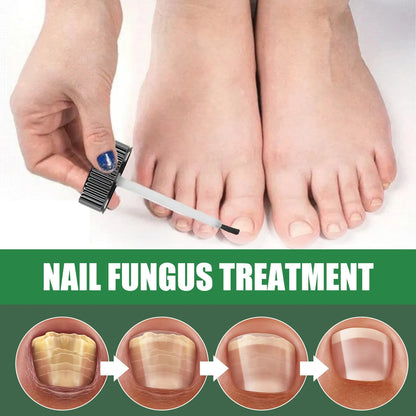 30ml bottle of tea tree oil nail repair fluid for hand and foot nail treatment