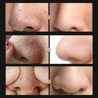 Blackhead Shrinking Combination Kit with Nasal Liquid and Serum for clear skin