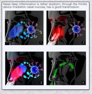 Infrared Rhinitis Therapy Device - an innovative medical device for natural allergy relief