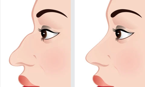 Electric Nose Lifter Device - Non-Surgical Nose Reshaping Tool for Bulbous, Crooked, or Flat Noses