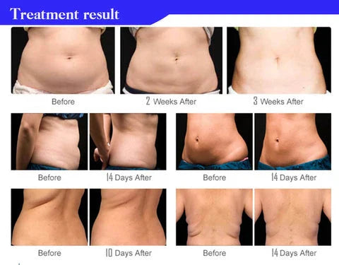 Ultrasonic Cavitation Fat Burner Device for Body Slimming and Anti-Cellulite Treatment