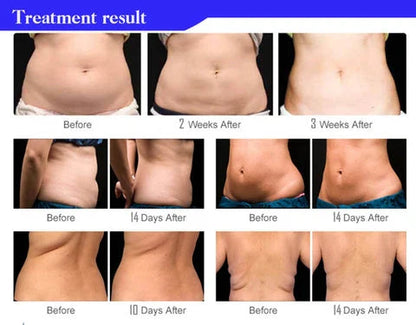 Ultrasonic Cavitation Fat Burner Device for Body Slimming and Anti-Cellulite Treatment