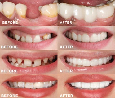 A close-up view of a set of snap-on dentures with a natural-looking appearance, designed to transform your smile instantly.