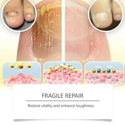 50ml bottle of nail fungus care solution containing bee venom and peppermint oil