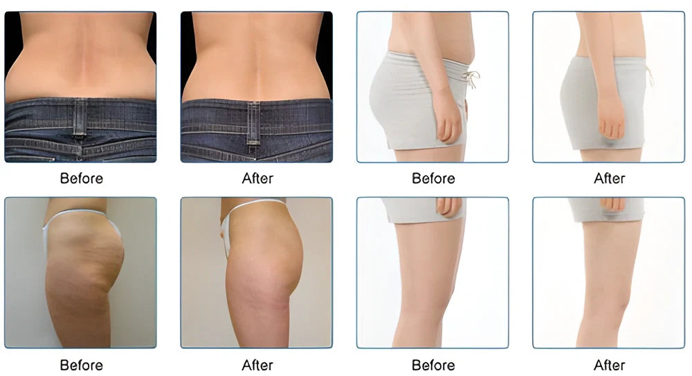 Acupressure Slimming Insoles with magnets and raised nodes for weight loss and foot pain relief